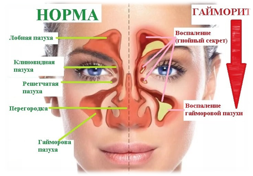 Если заложены гайморовы пазухи